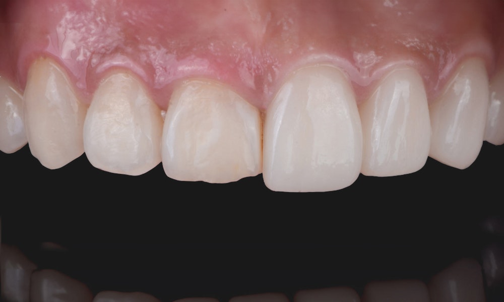 before and after Crown lengthening