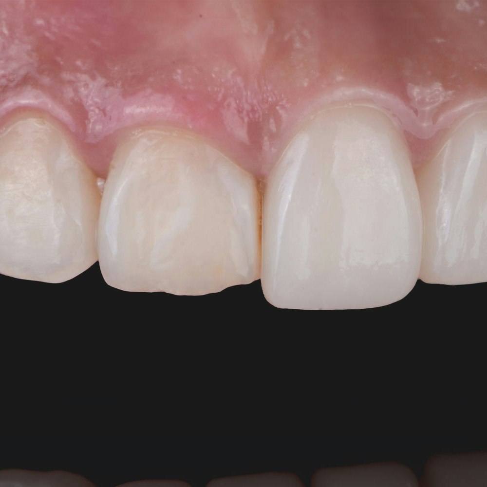 before and after Crown lengthening