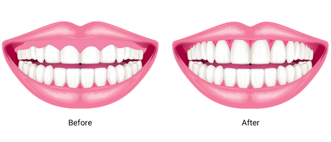 Side by side illustrations of a smile before and after removal of excess gum tissue