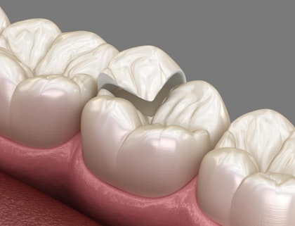 Onlay dental crown