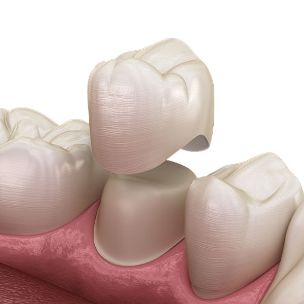 dental crowns