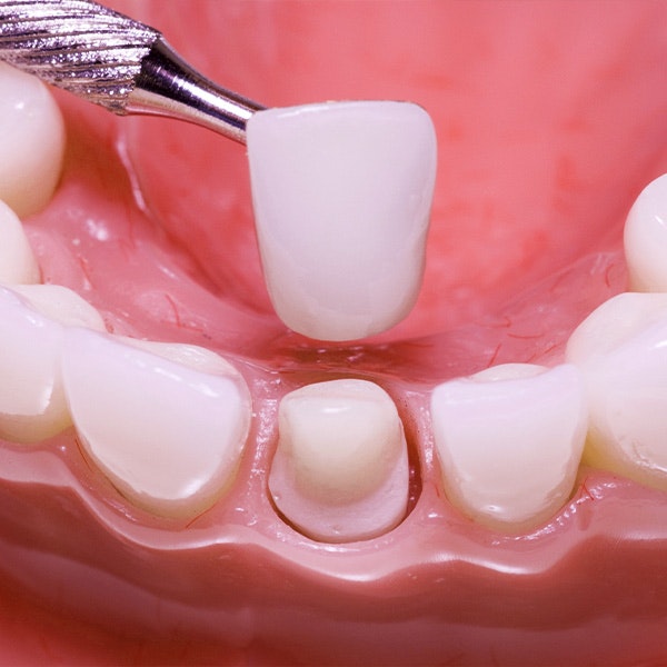 Crown being placed over tooth