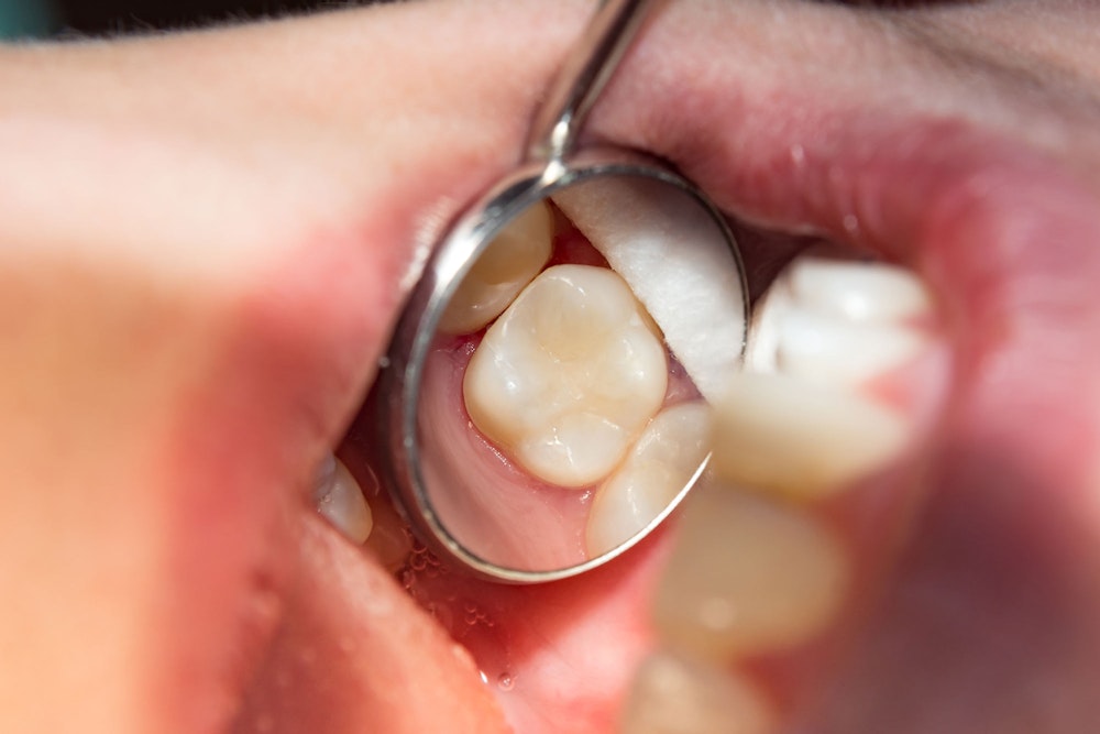 Dental crown on tooth