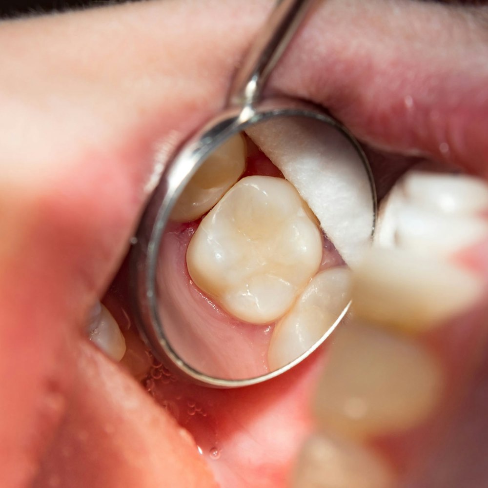 Crown after root canal procedure