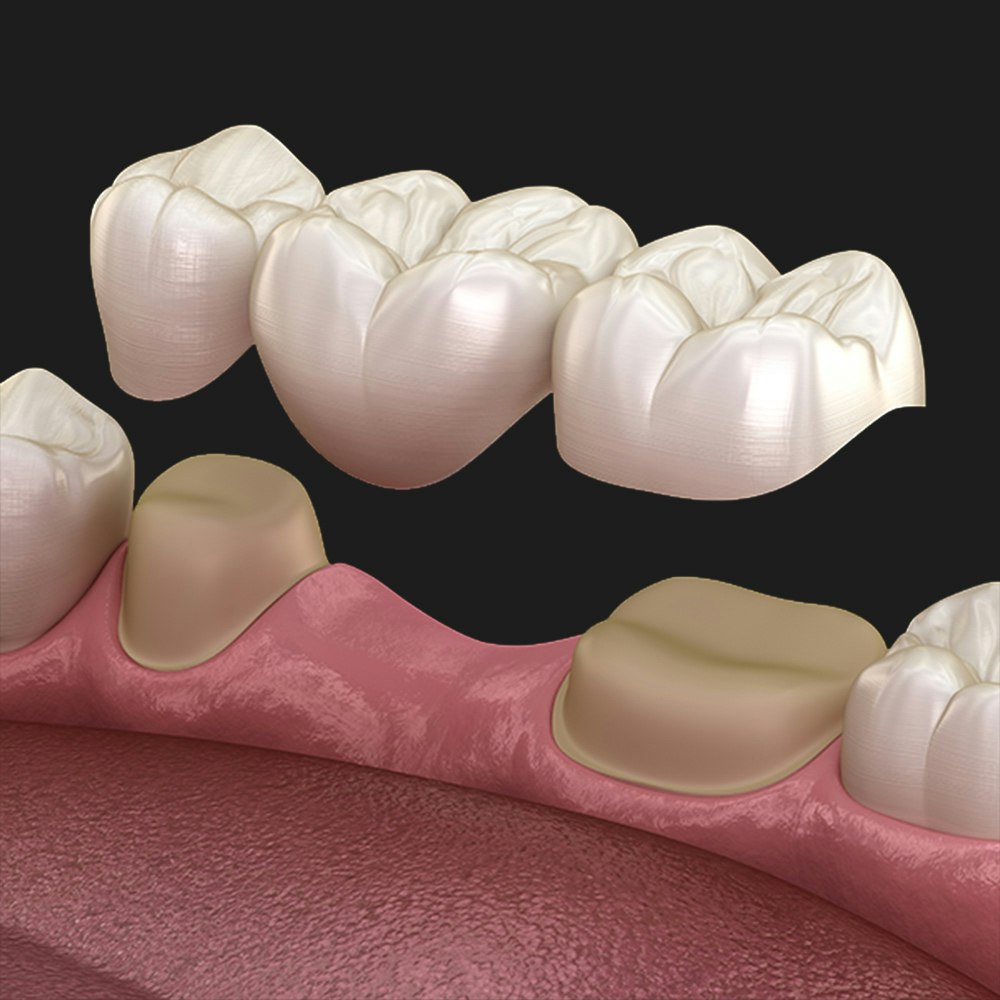 traditional dental bridge