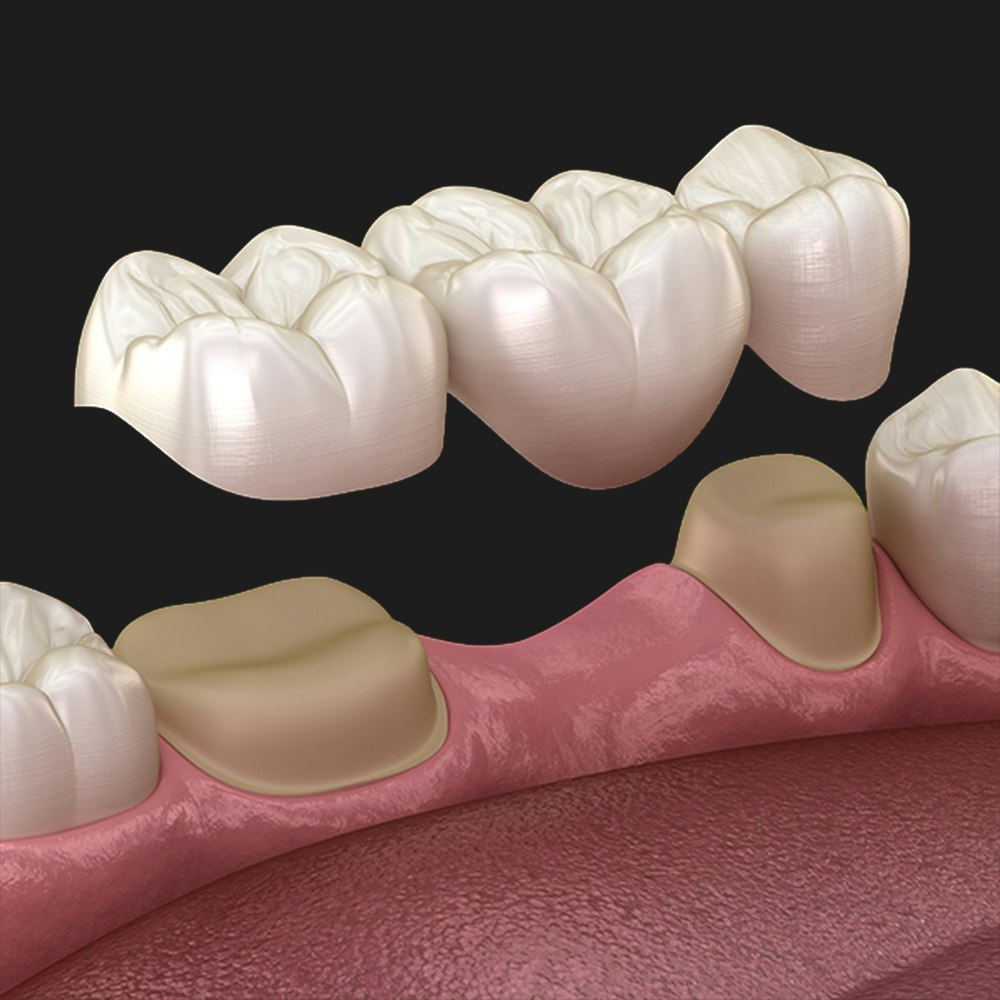 Dental Bridge