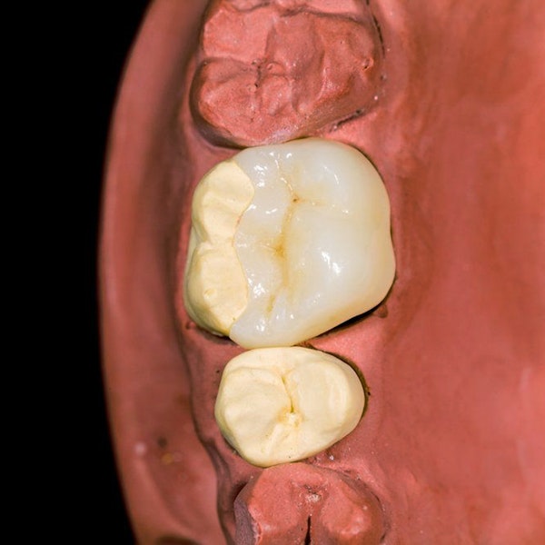 Dental inlay