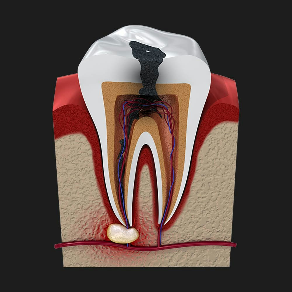 Root canal illustration
