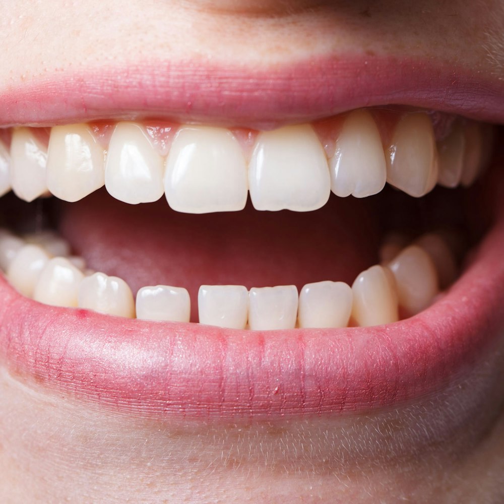 Close up of teeth in need of dental bonding
