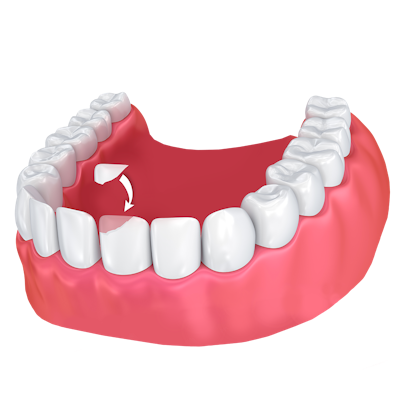 dental bonding illustration