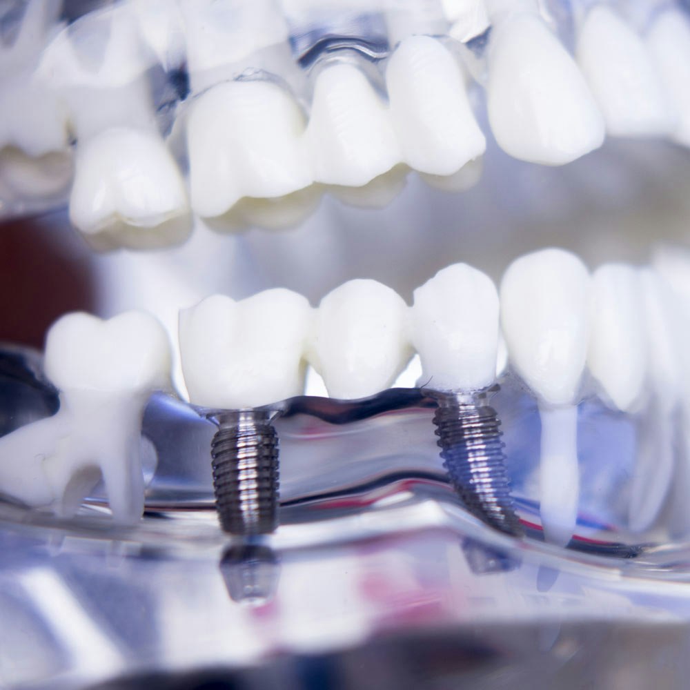 Dental implant bridge