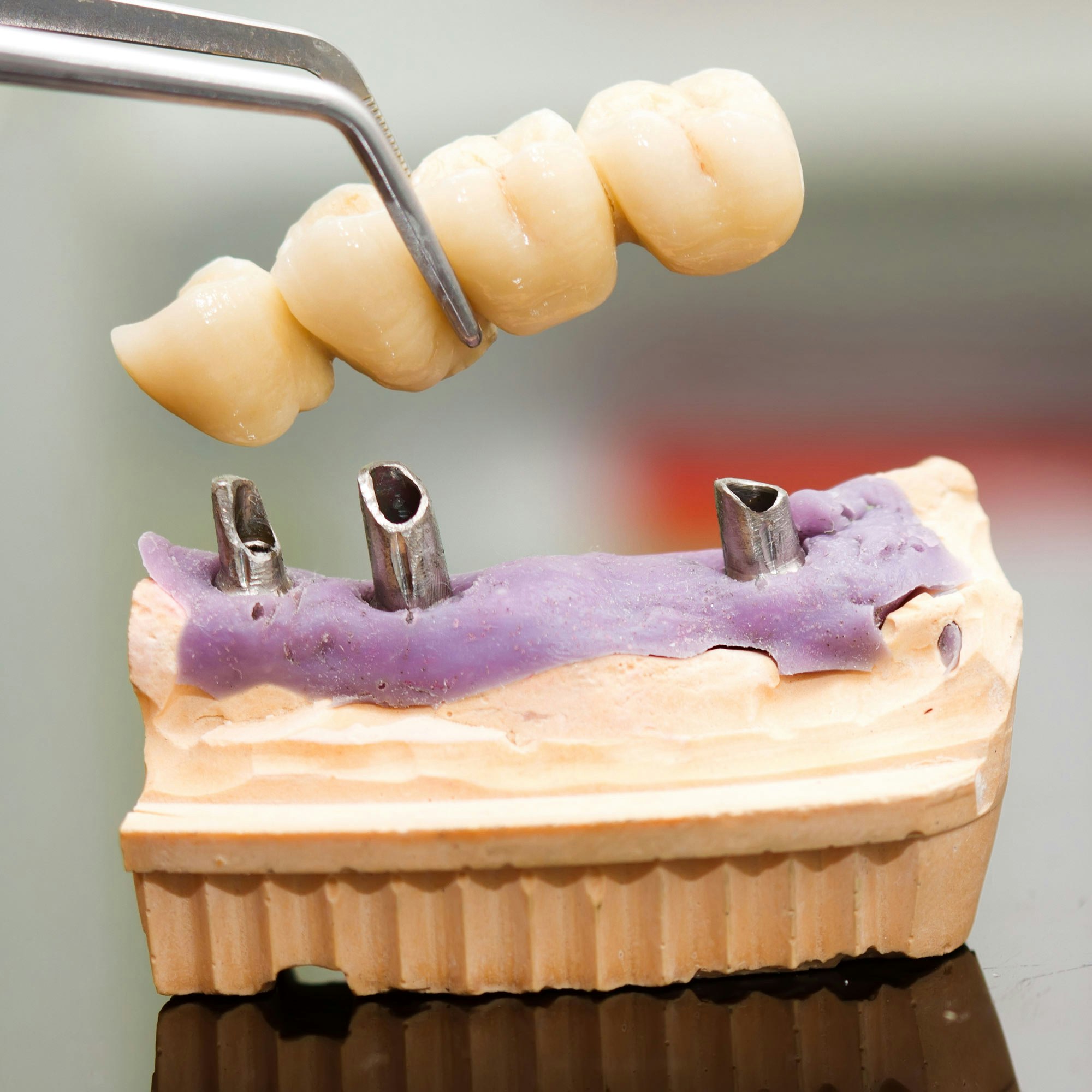 implant-supported dental bridge