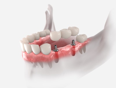 Implant-Supported Dental Bridge