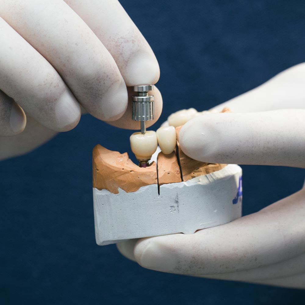 Gloved hands holding dental crown and model of teeth