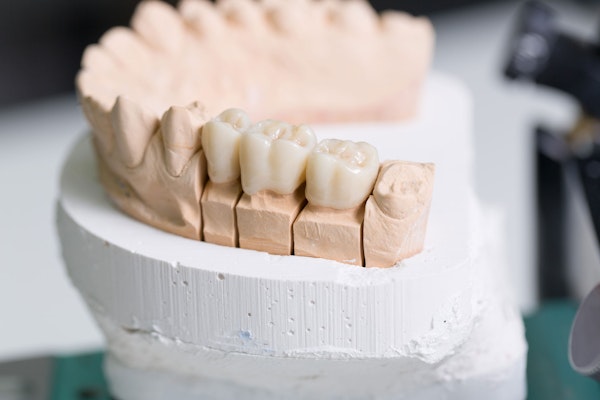 Dental bridge in model of dental arch