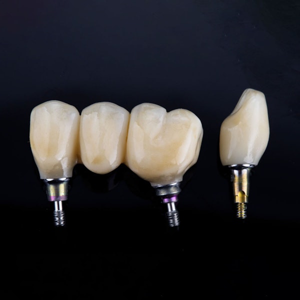 Implant-supported restorations