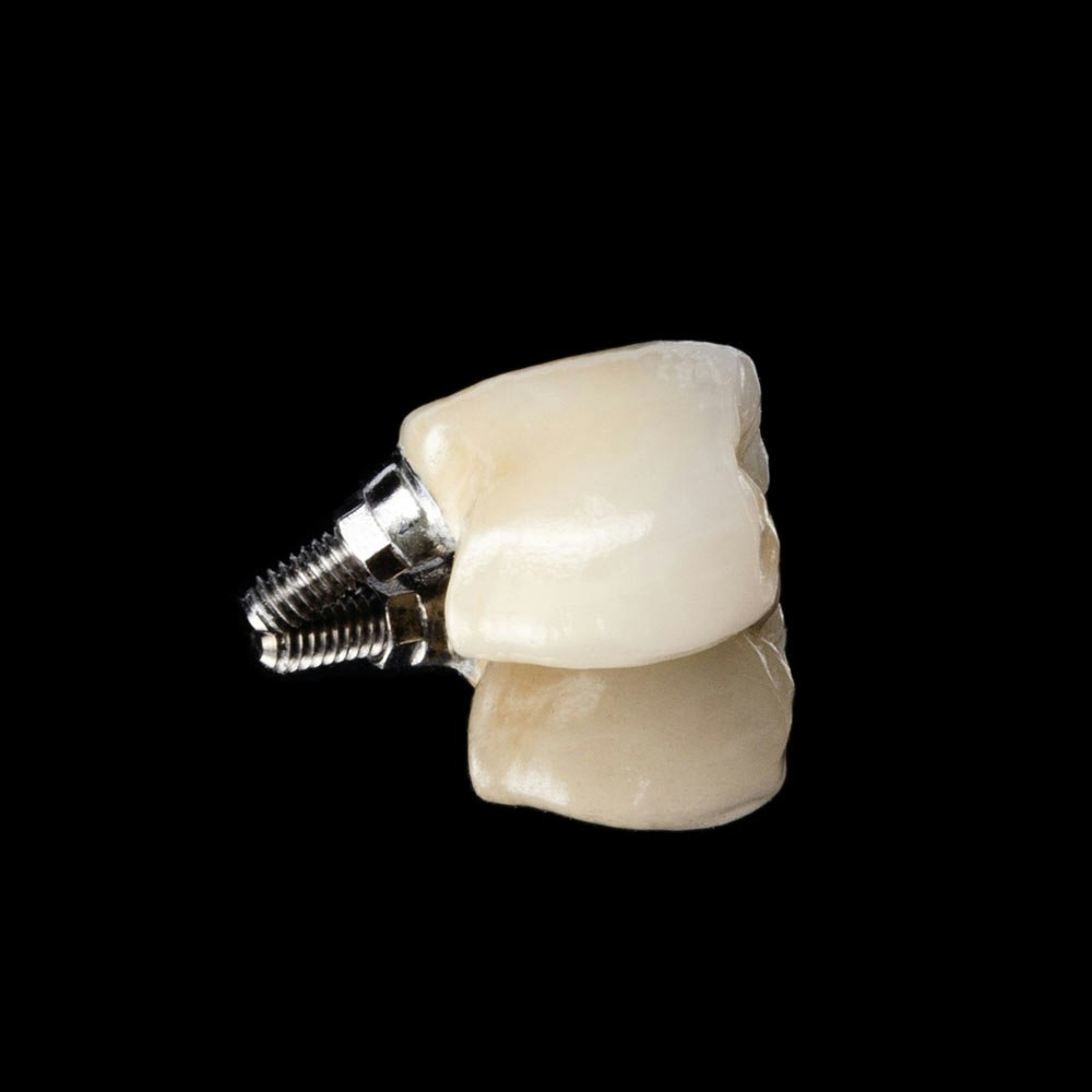Dental implant