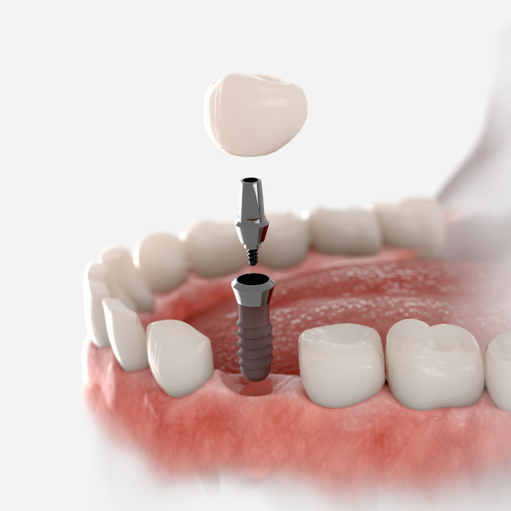 illustration of an implant-supported crown