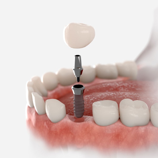 Implant crown