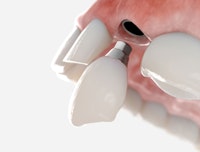 Dental implant