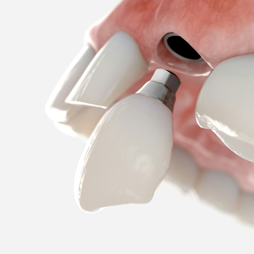 Same-day dental implant