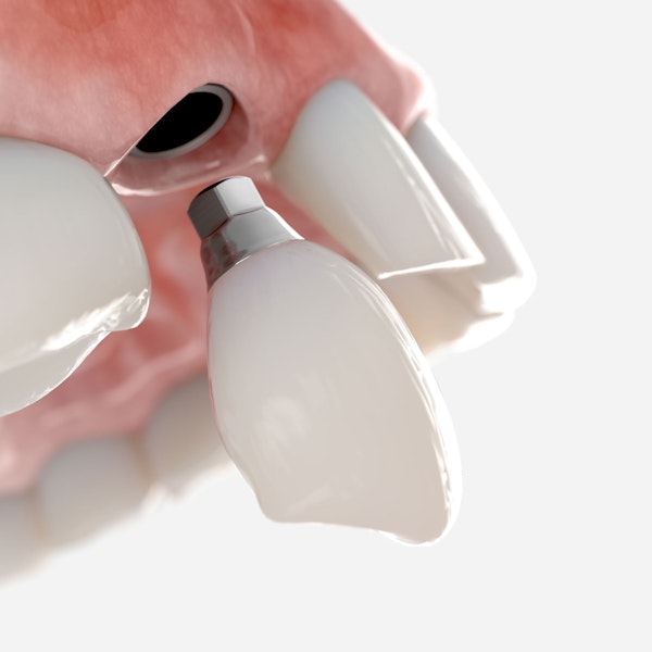 Implant-supported crown
