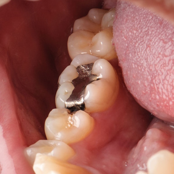 metal dental filling