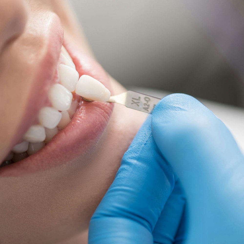 patient looking at veneer shade