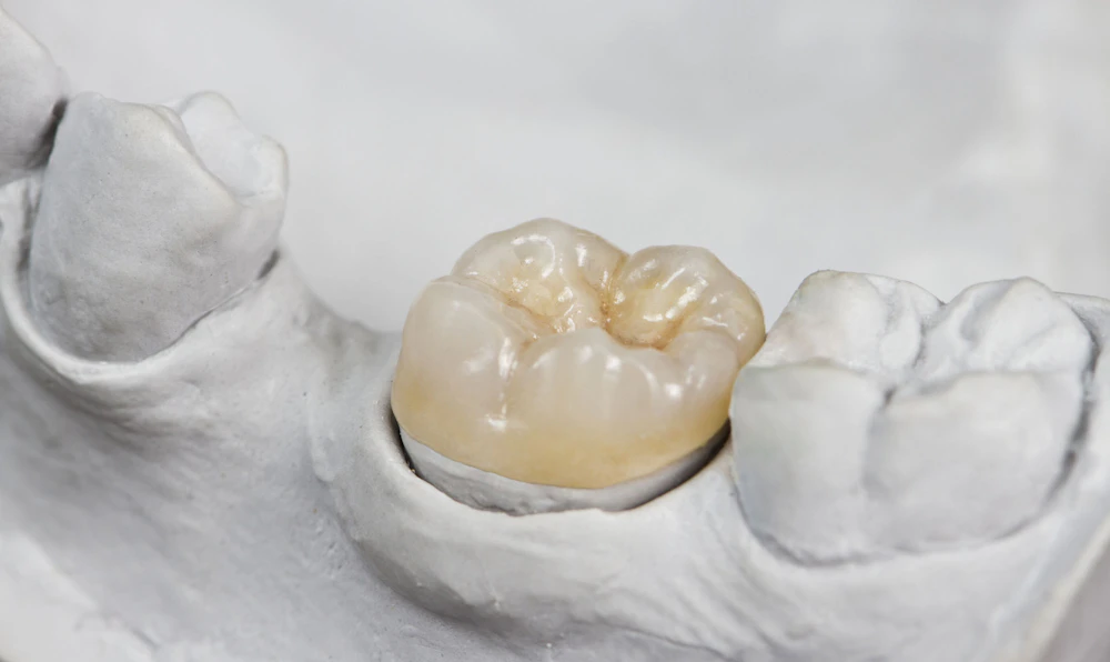 image of a dental crown on a mold