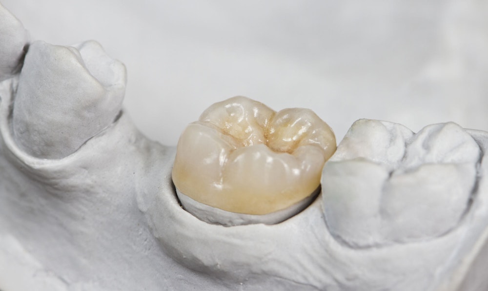 image of a dental crown on a mold