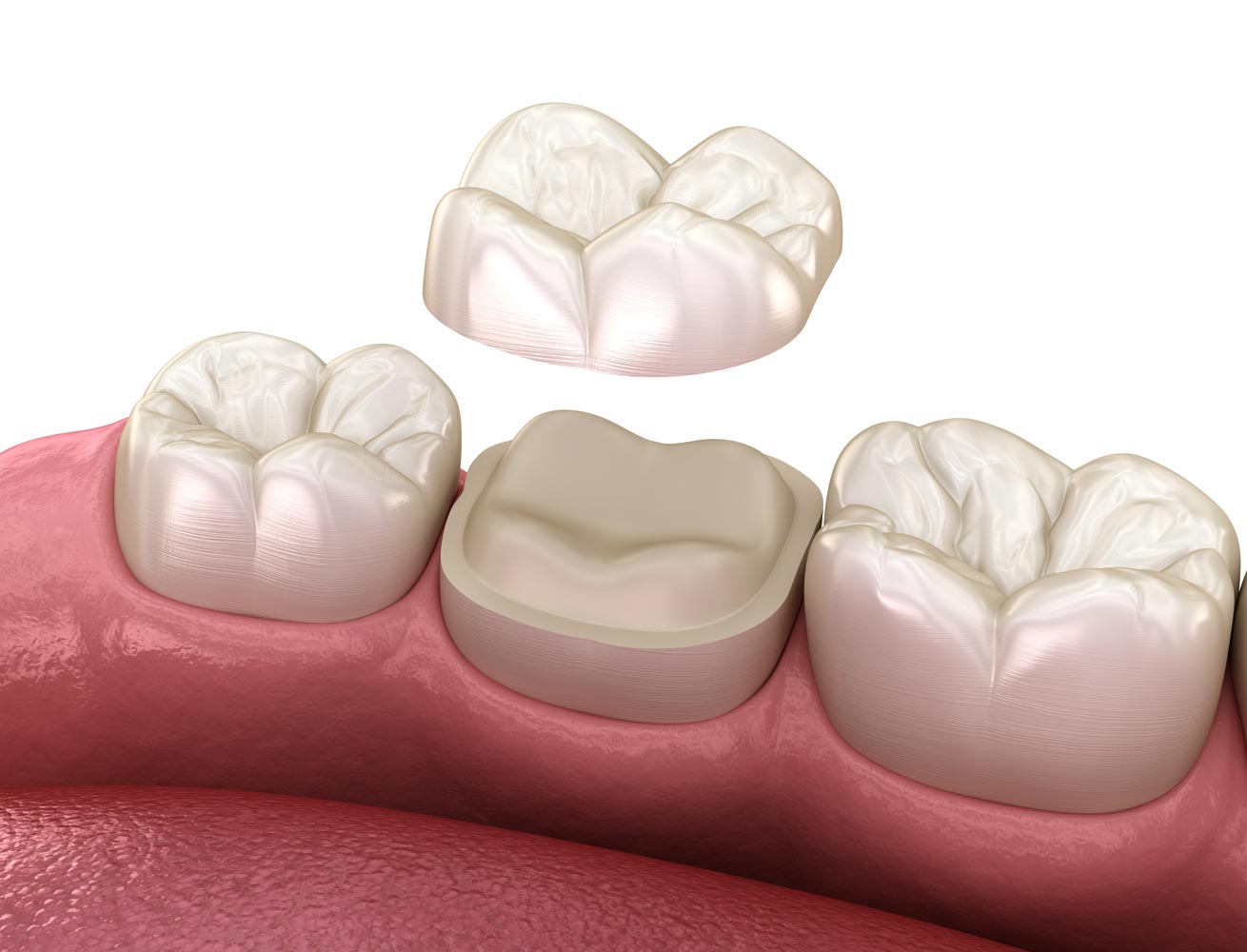Dental crown over tooth