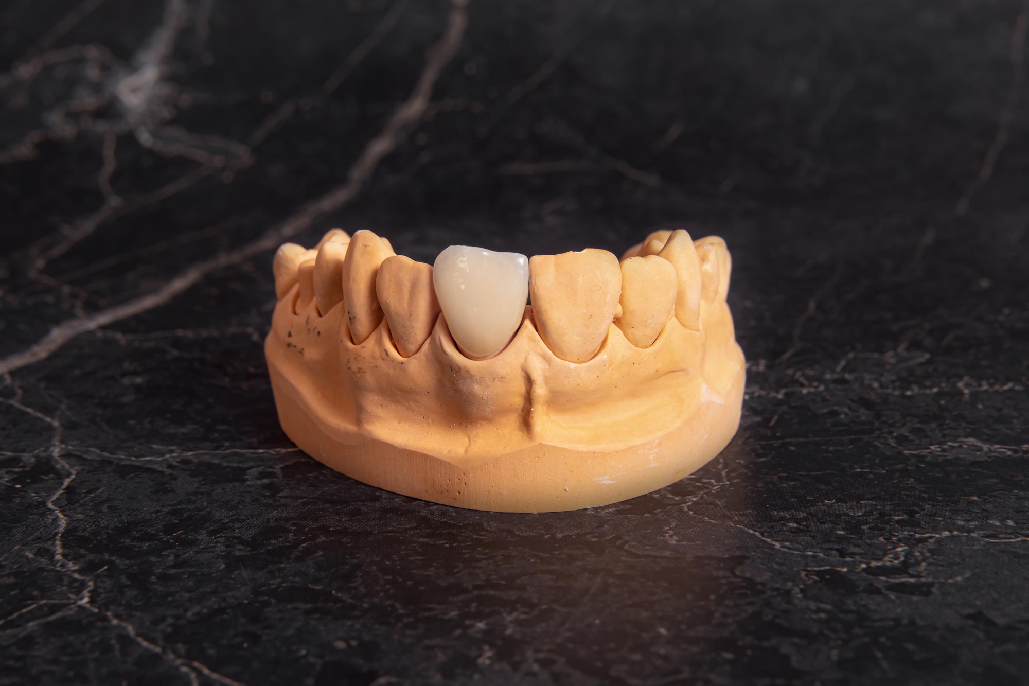 jaw model with dental crown