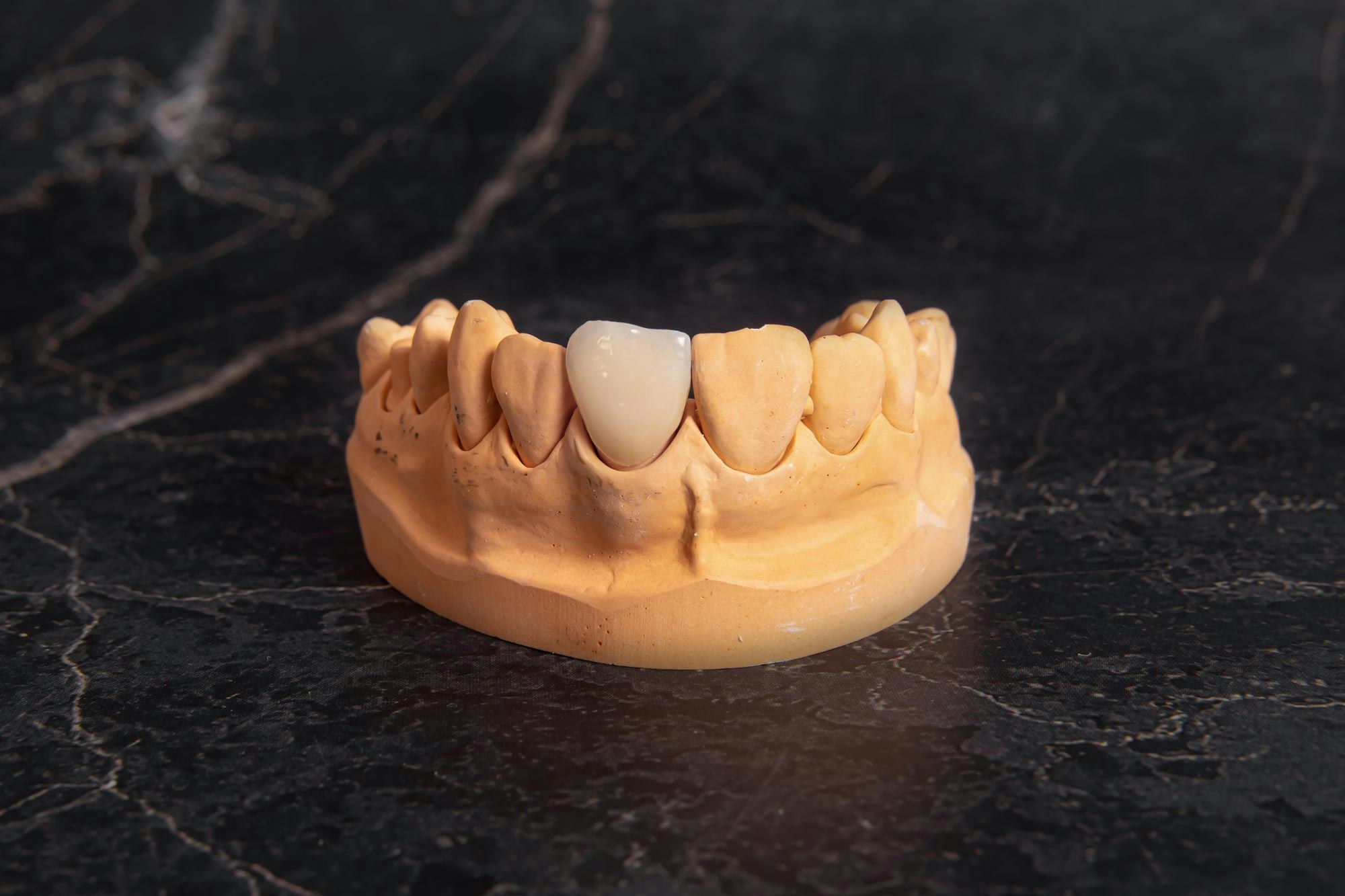 jaw model with dental crown