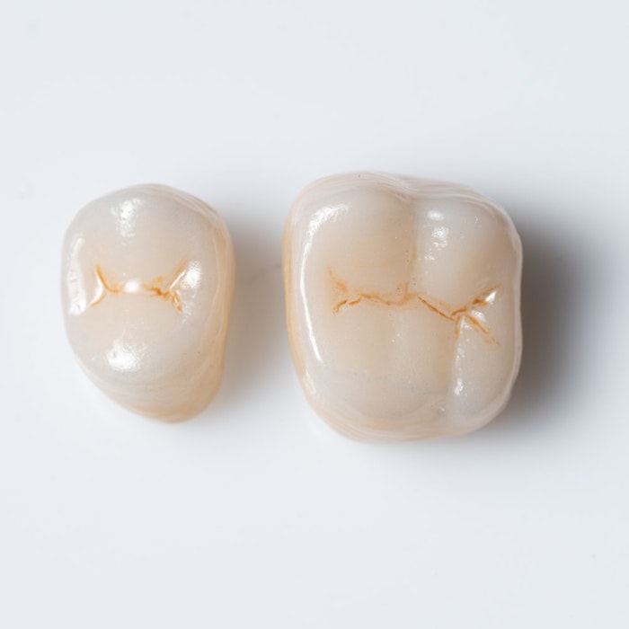 Tooth prepped for crown