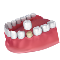 dental crown being applied to a tooth