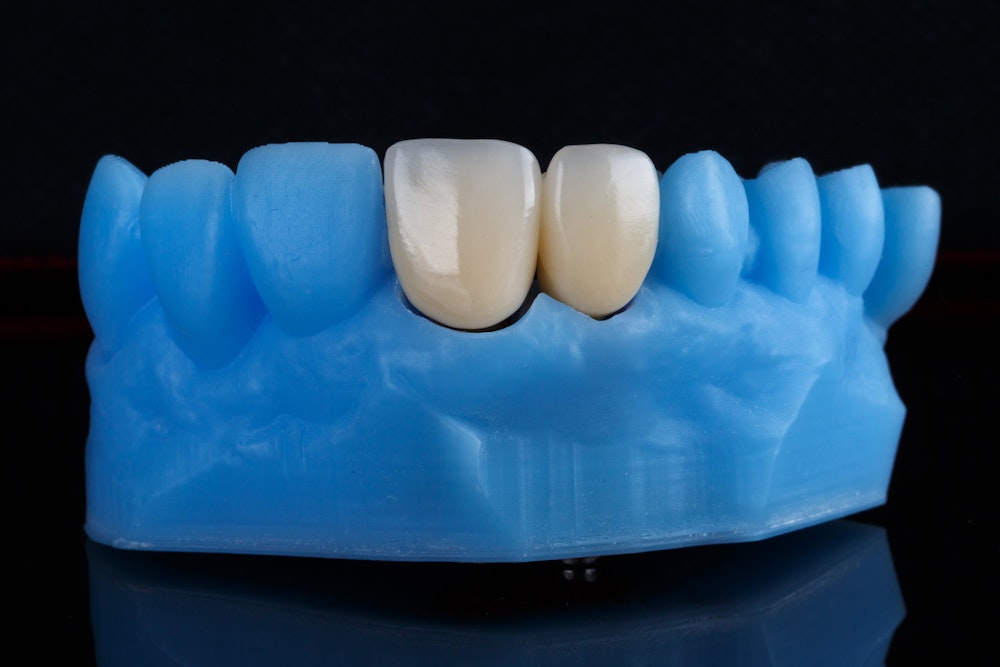 Dental crowns on model teeth