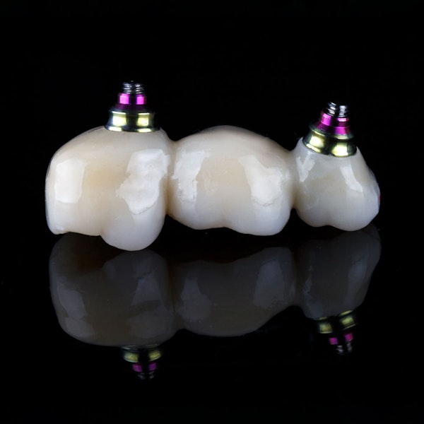 Dental bridge implant