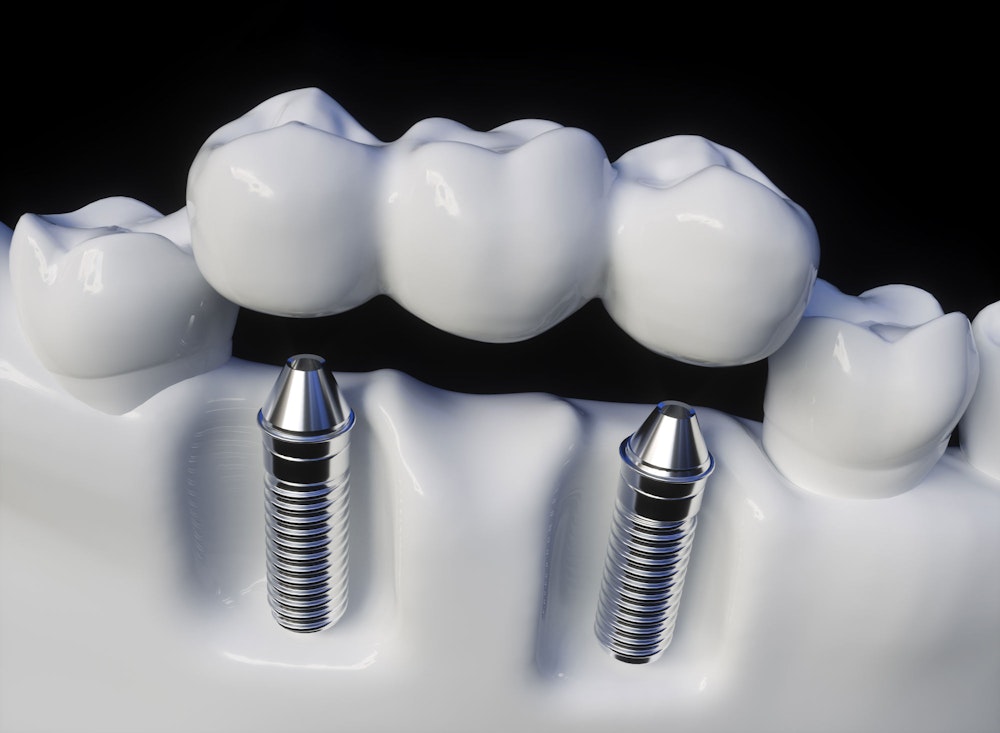A dental implant supporting a crown in an arch of teeth