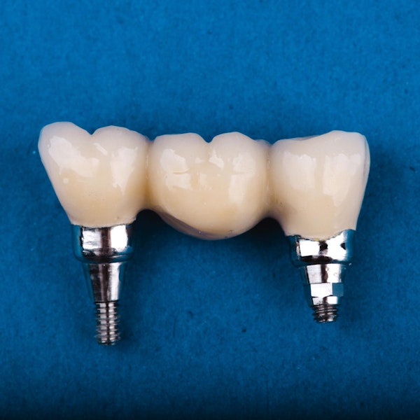 dental implant bridge