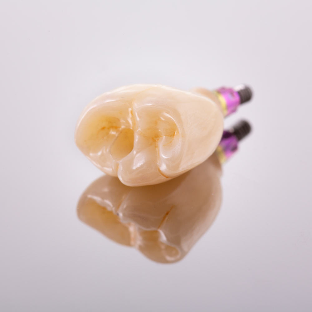 dental implant model