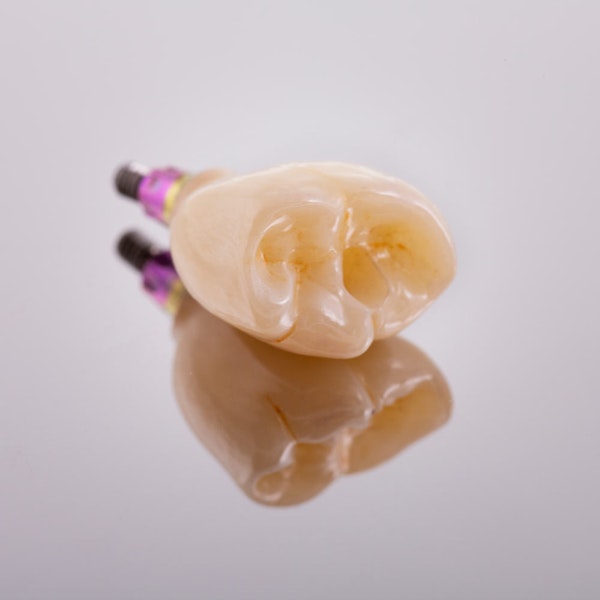 dental implant model