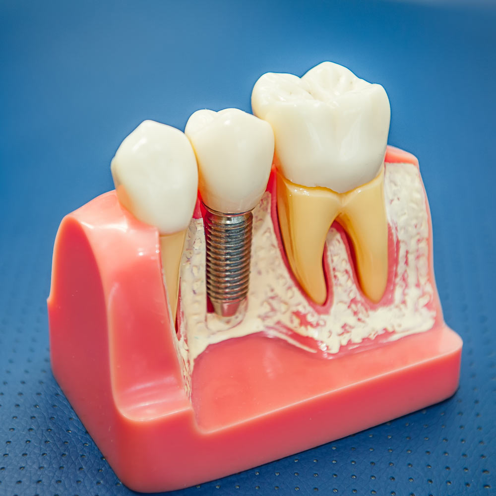 Dental implant on model