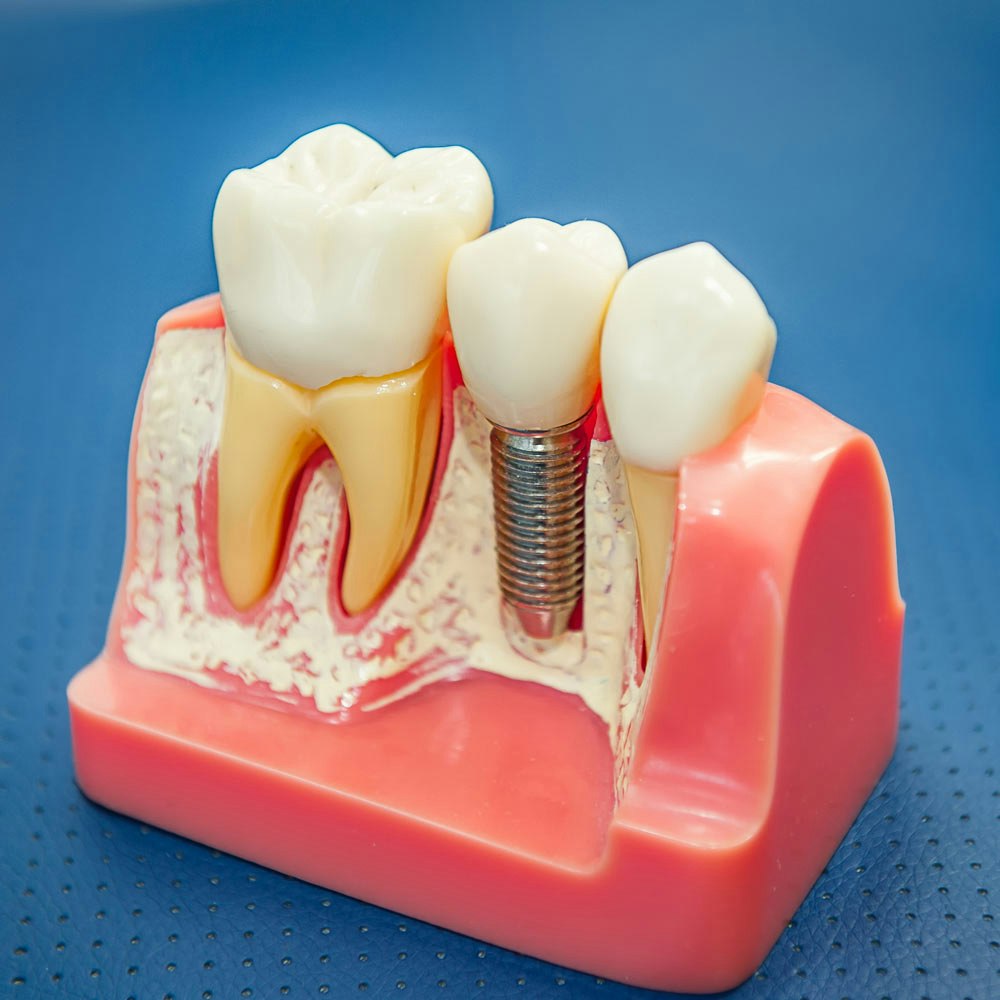dental implant model
