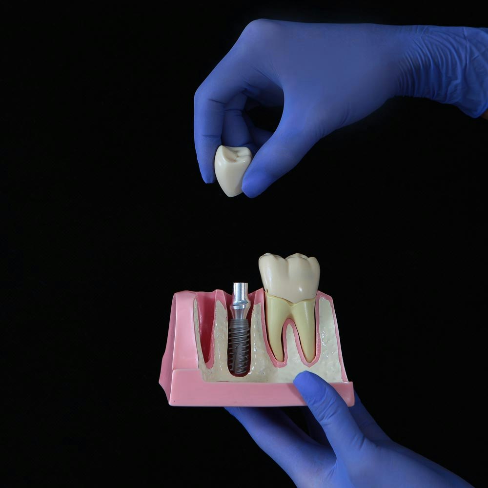 Dentist placing crown on dental implant