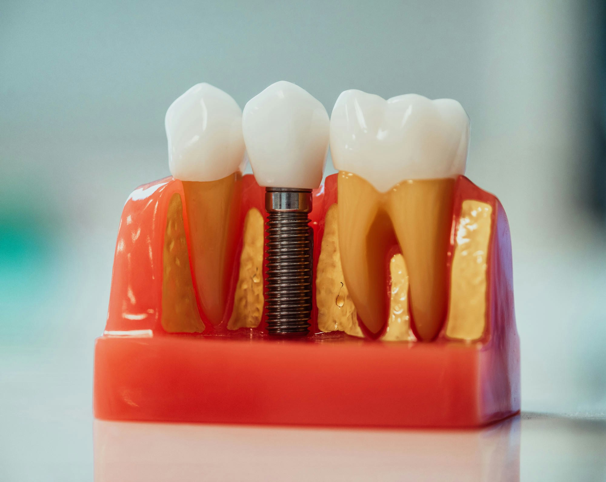 dental implant model