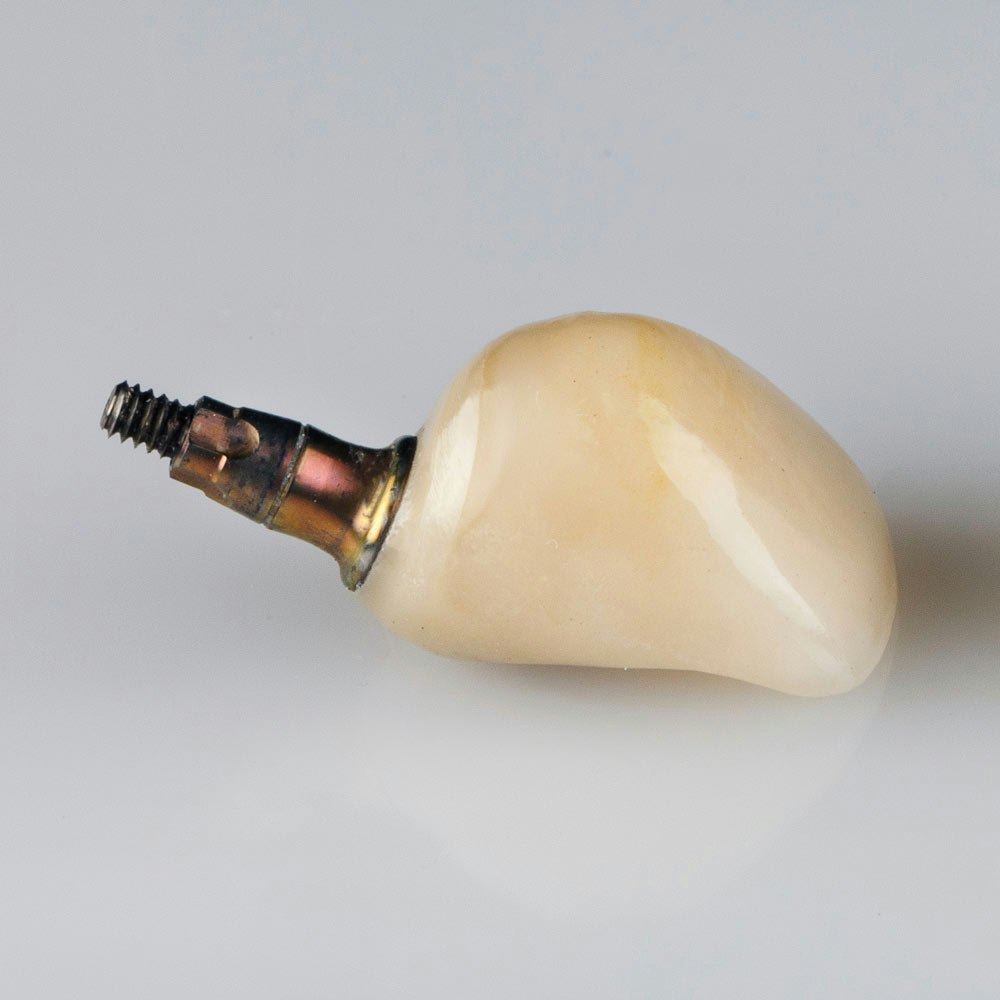 implant-supported dental crown