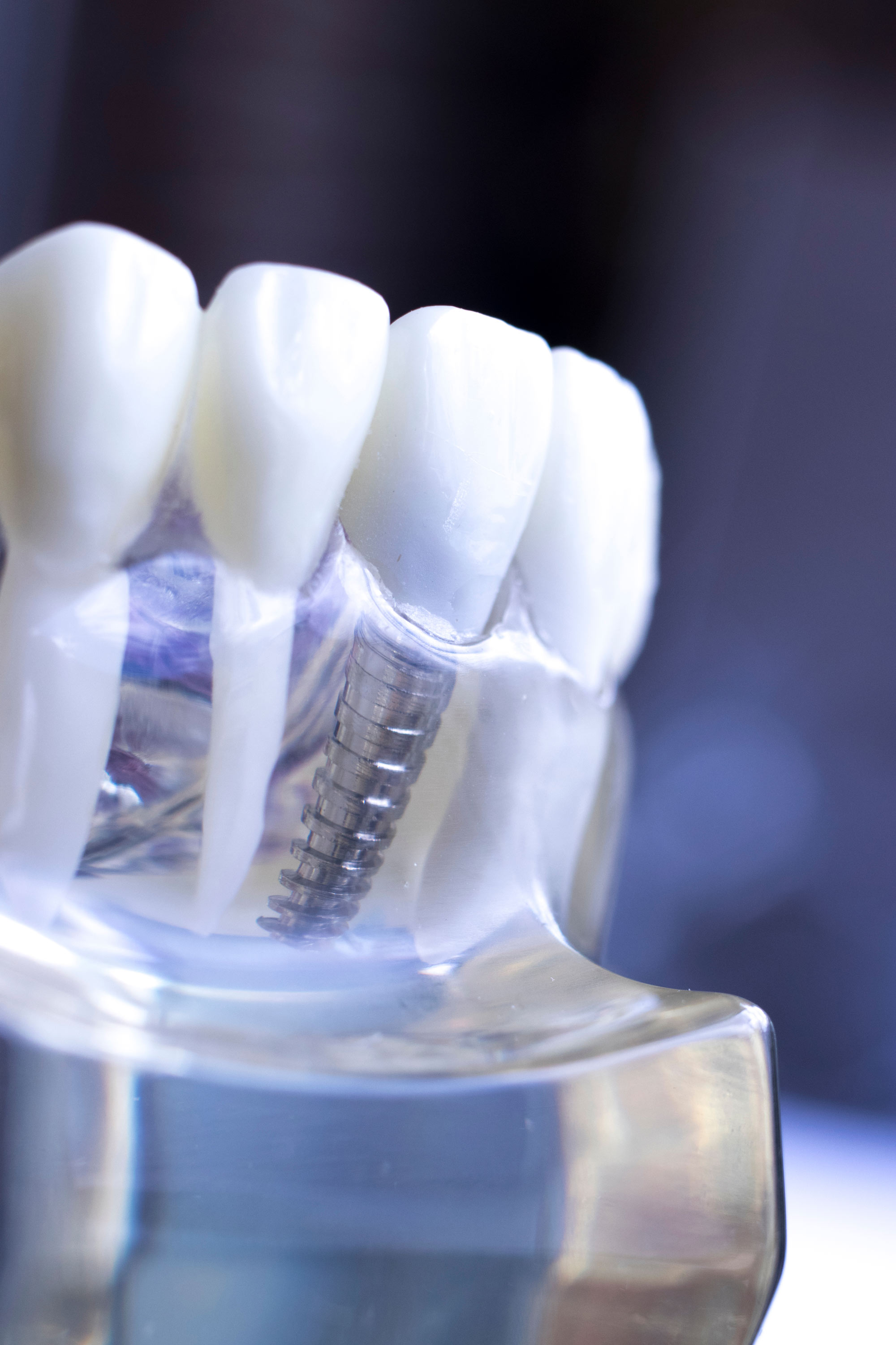 3d illustration of a dental implant in two different graphic styles. Solid  and transparent technical image (glass) on a blue background Stock Photo -  Alamy