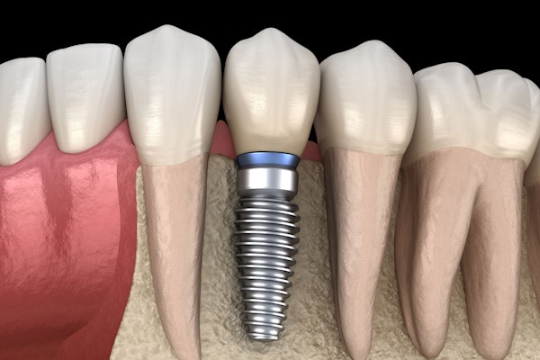 Dental Crowns