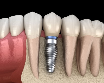 implant-supported crown