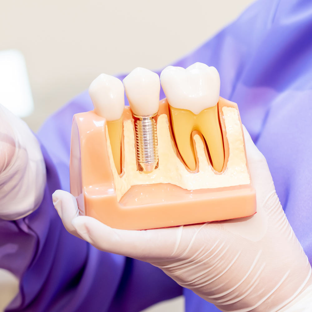 Dental implant model